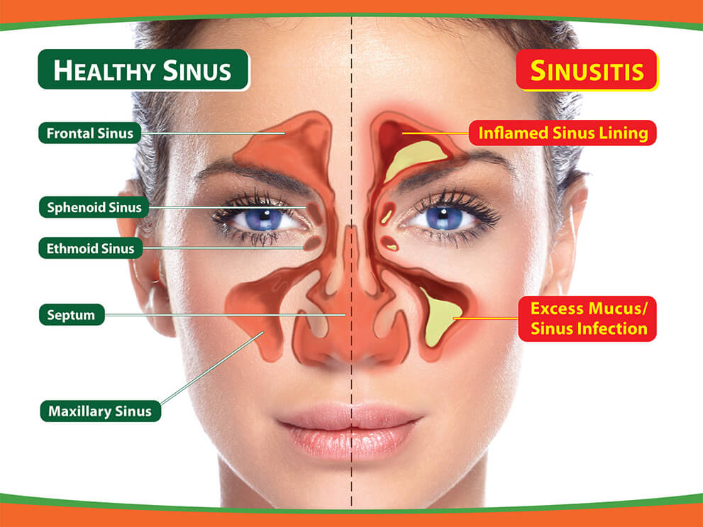 Sinus Diagram Asthma, Rhinitis, Sinusitis-Presumptive Service Connections