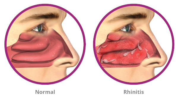 rhinitis image Asthma, Rhinitis, Sinusitis-Presumptive Service Connections